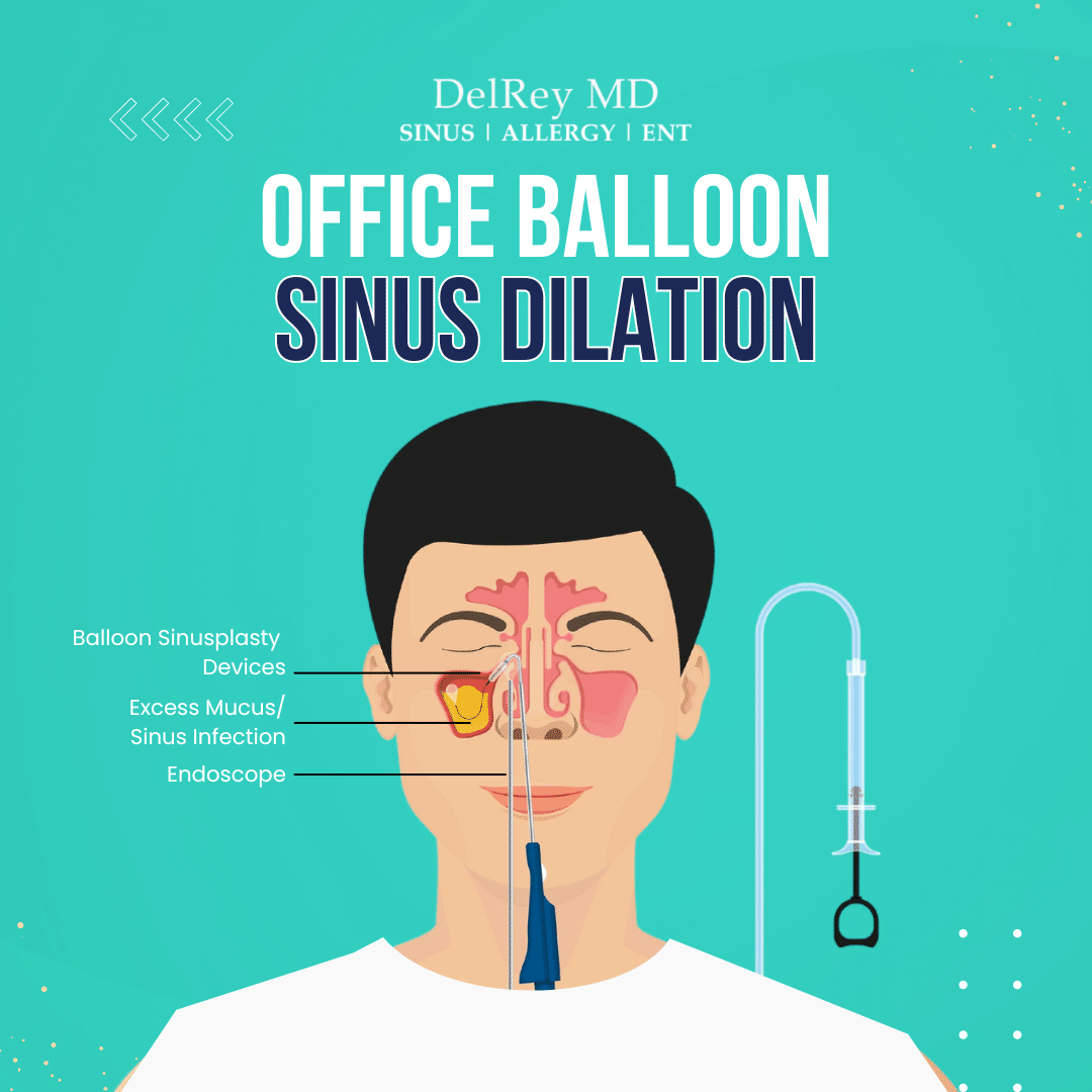 Office Balloon Sinus Dilation