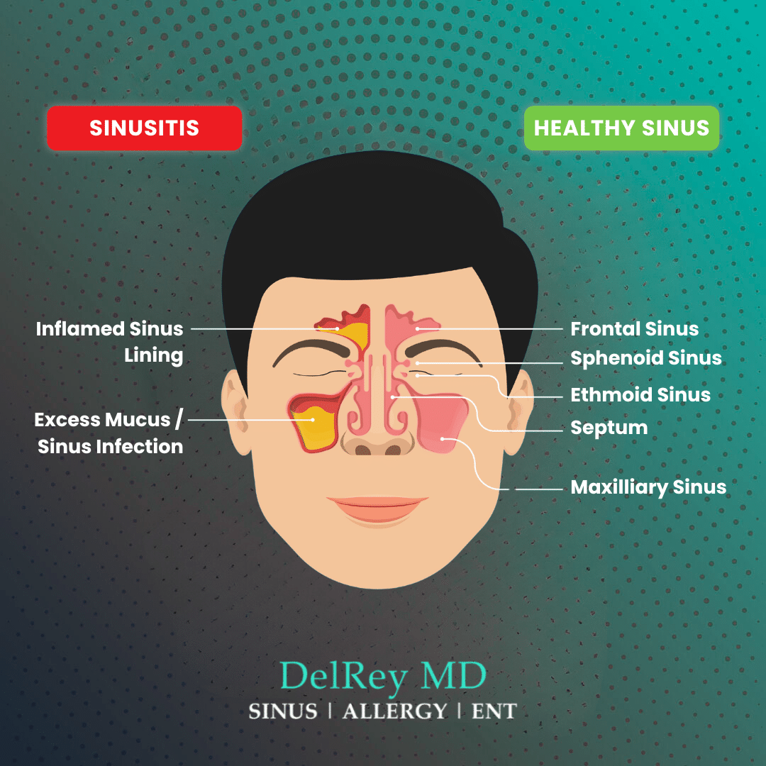 Stop Sinusitis
