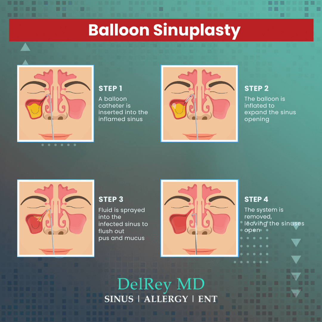Balloon Sinuplasty