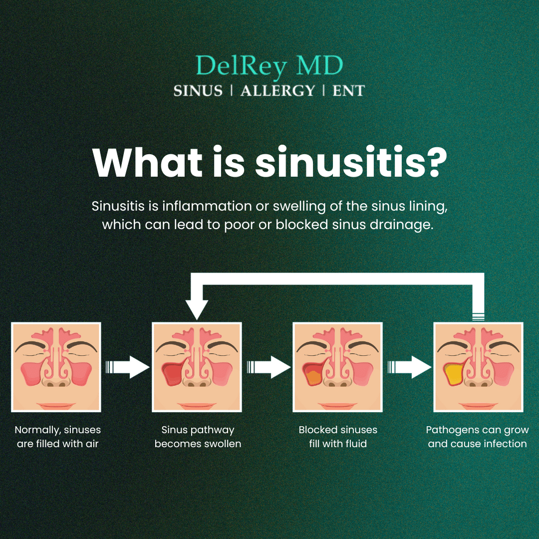 What Is Sinusitis
