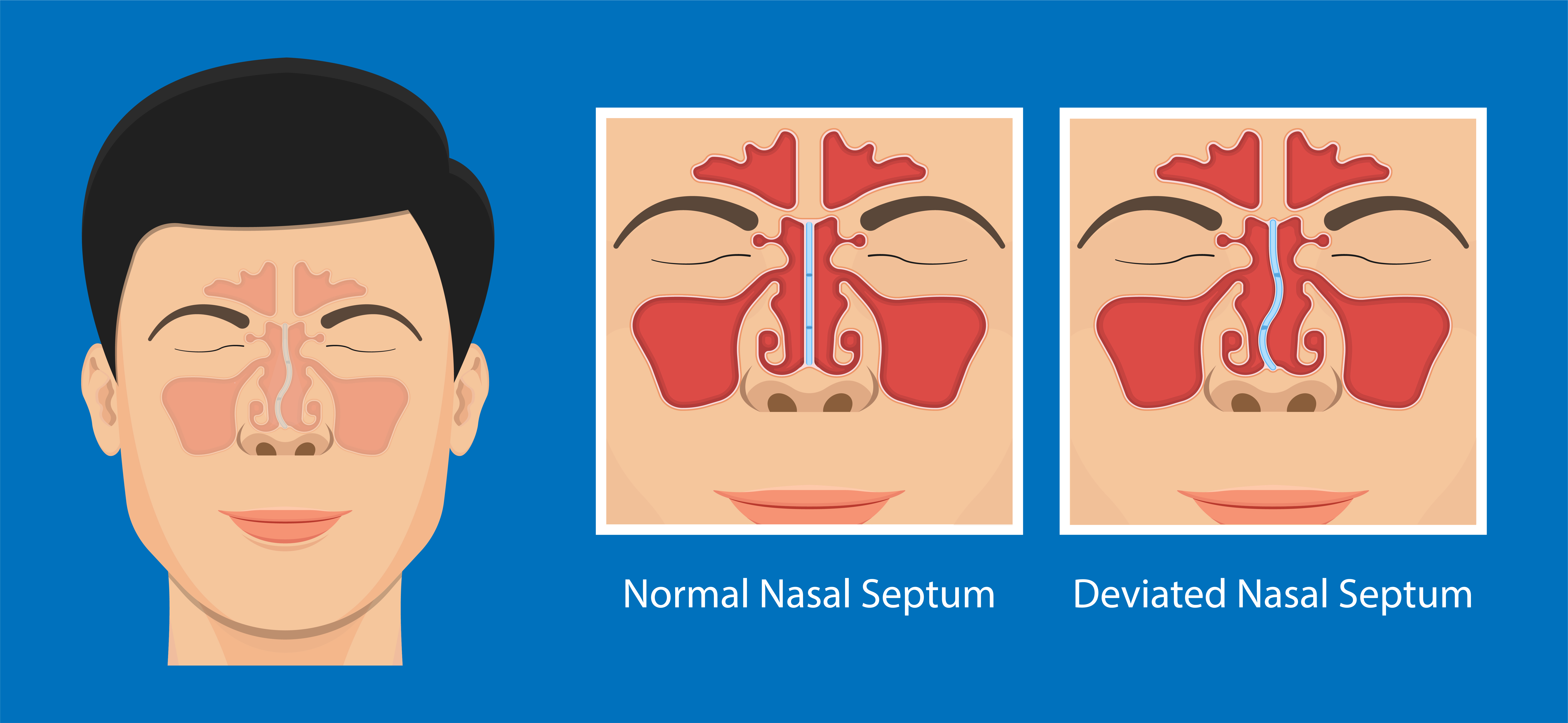 Diagram showing nose with deviated septum and how the nasal passages look after septoplasty (functional rhinoplasty). Diagram showing nose with deviated septum and how the nasal passages look after septoplasty (functional rhinoplasty).
