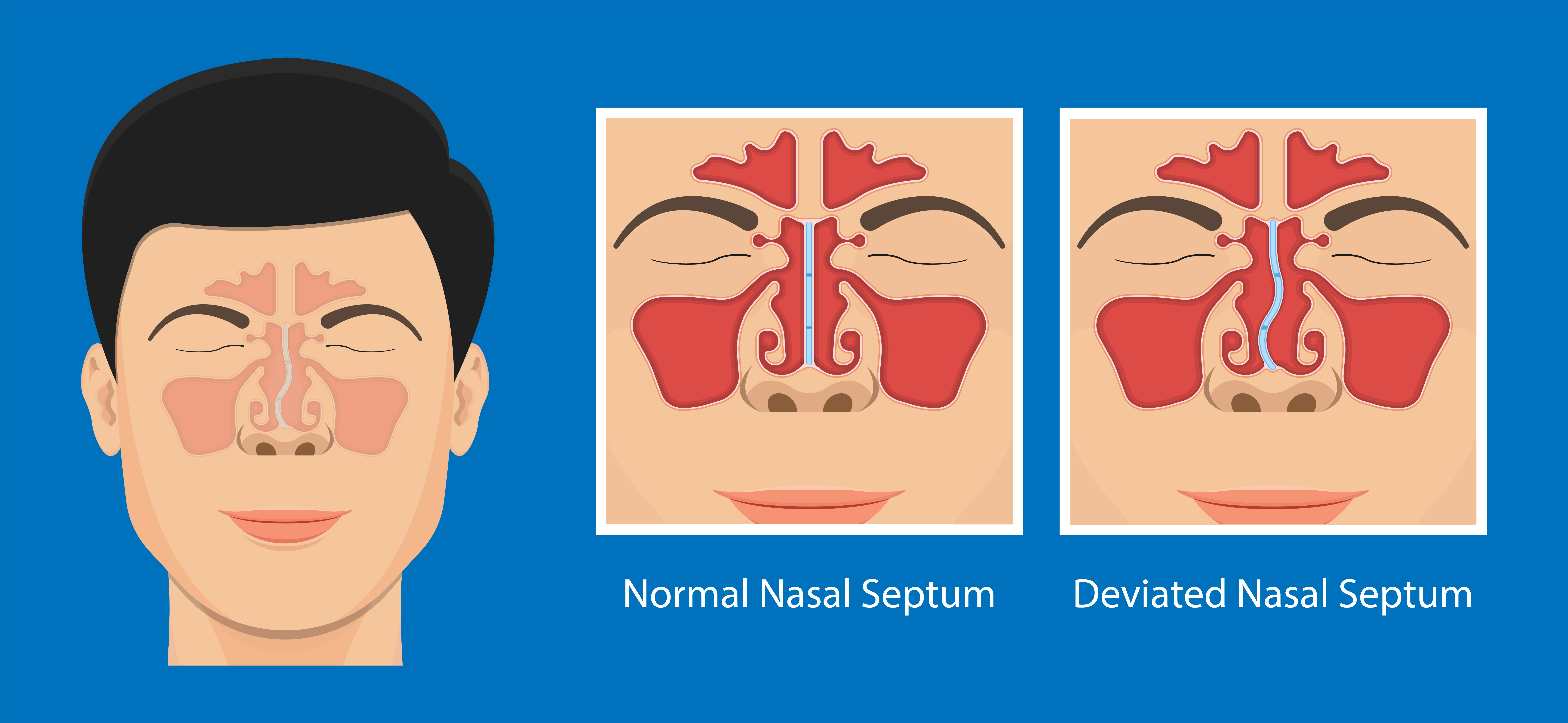 Diagram showing nose with deviated septum and how the nasal passages look after septoplasty (functional rhinoplasty).