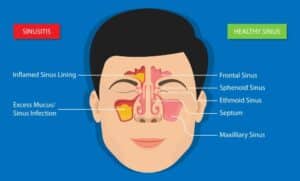 Healthy sinuses vs. chronic sinusitis needing Balloon Sinuplasty™ in Marina Del Rey, CA
