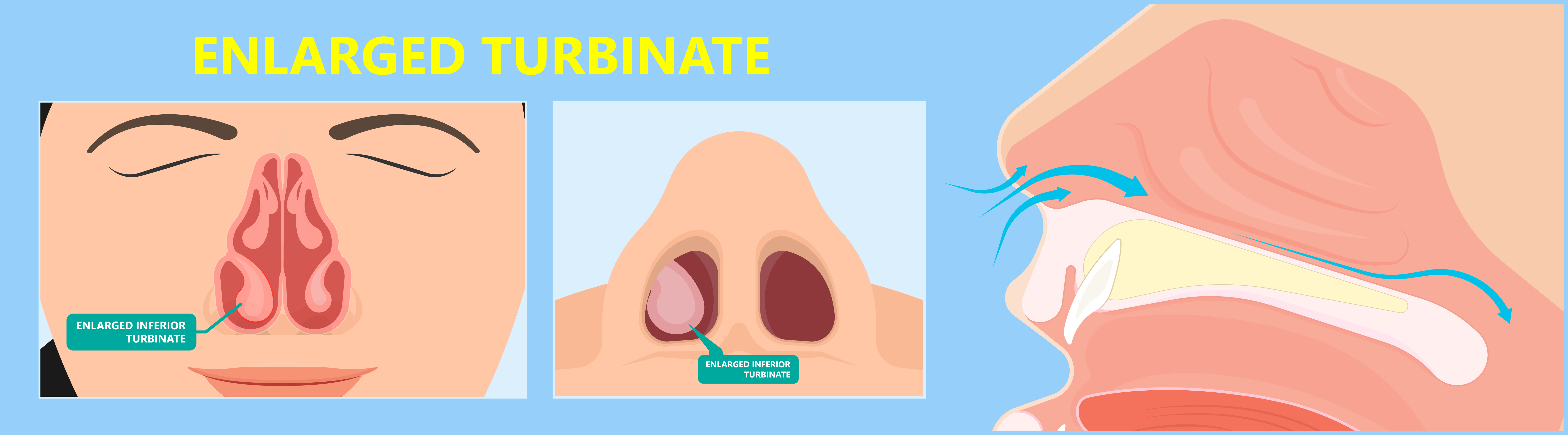 Illustration of a nasal obstruction in Marina Del Rey, CA